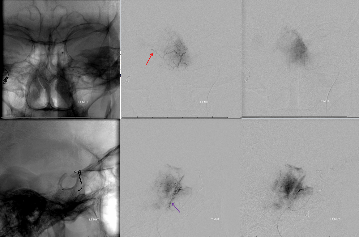 Petroclival Meningioma Embolization