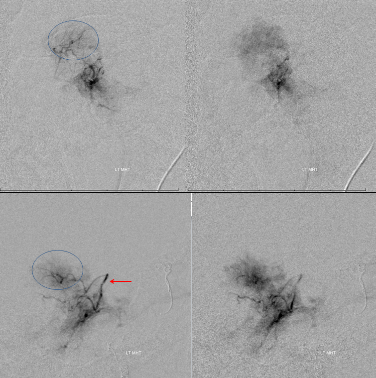 Petroclival Meningioma Embolization