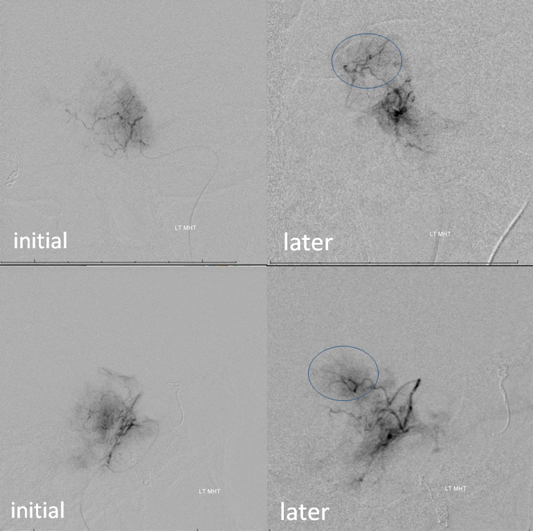 Petroclival Meningioma Embolization