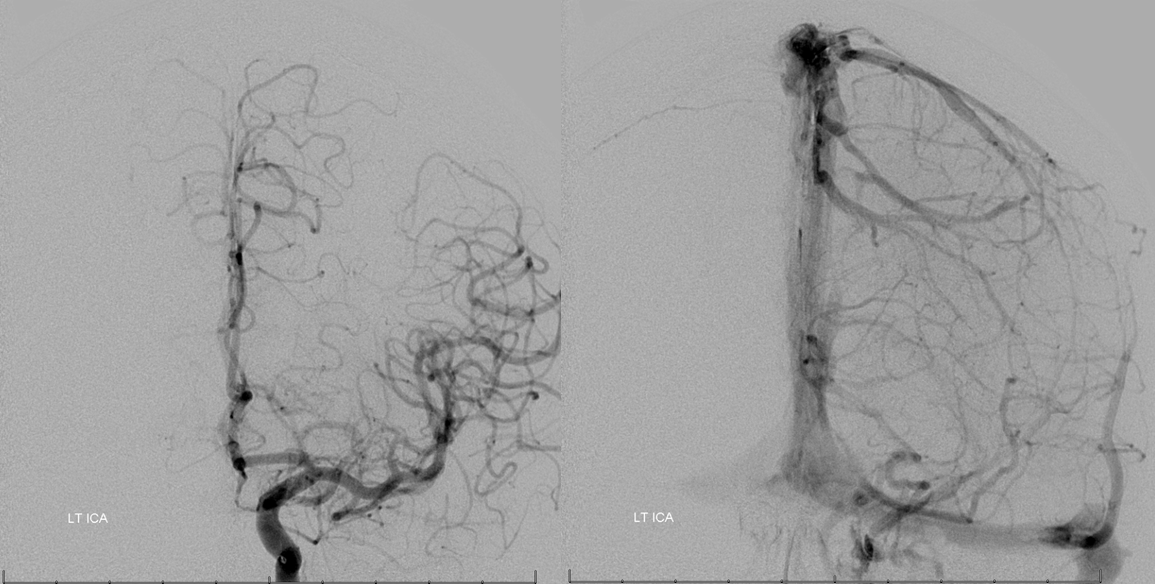 Petroclival Meningioma Embolization