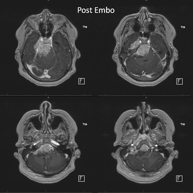 Petroclival Meningioma Embolization