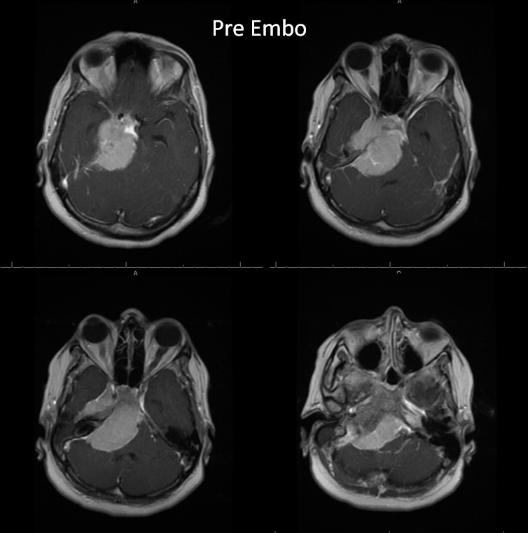 Petroclival Meningioma Embolization