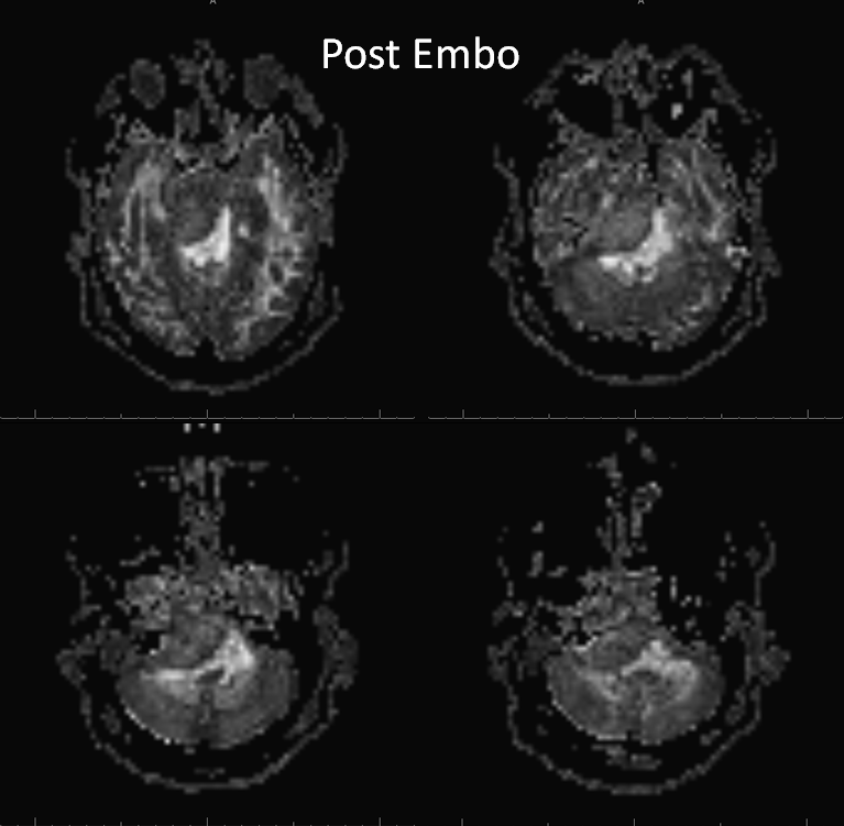 Petroclival Meningioma Embolization