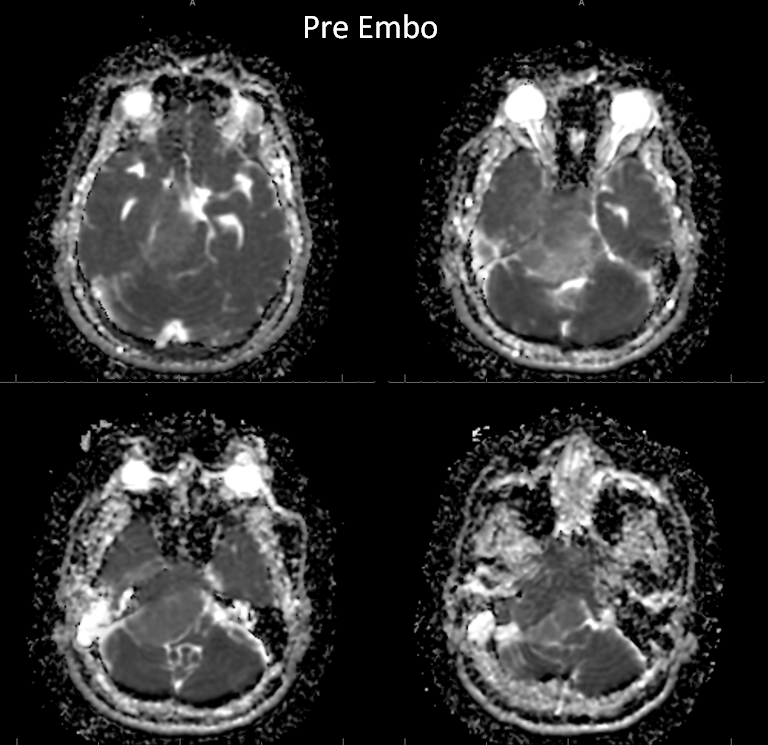 Petroclival Meningioma Embolization