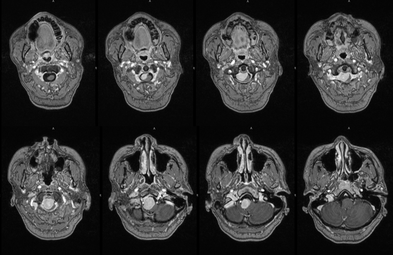 Foramen Magnum Mening Embolization