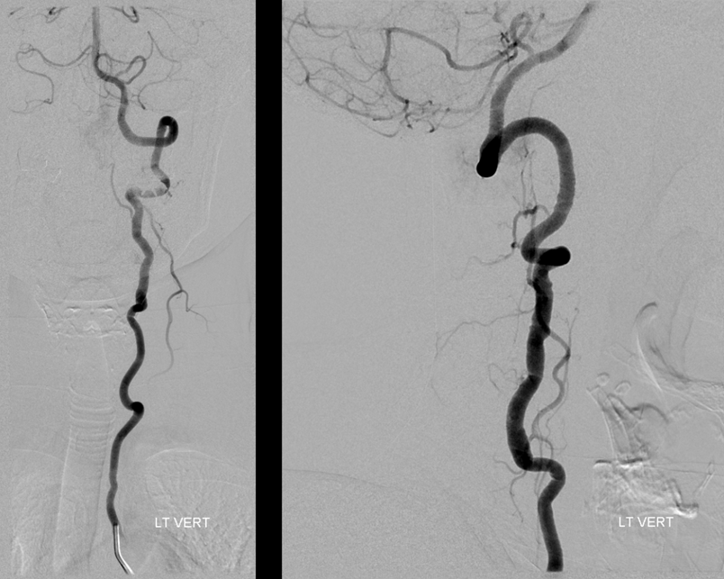 Foramen Magnum Mening Embolization