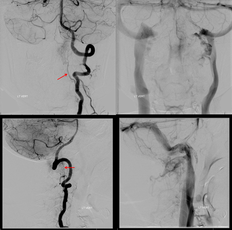 Foramen Magnum Mening Embolization