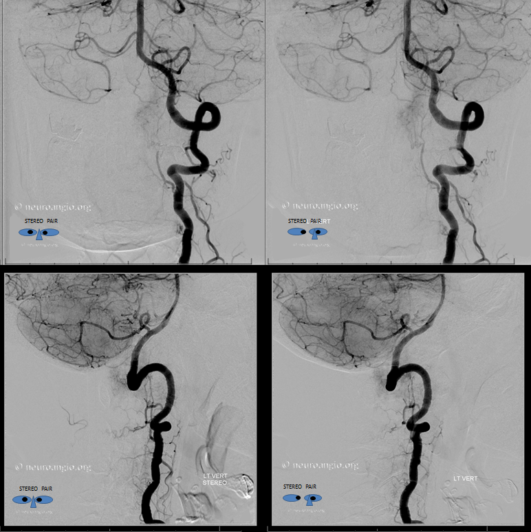 Foramen Magnum Mening Embolization