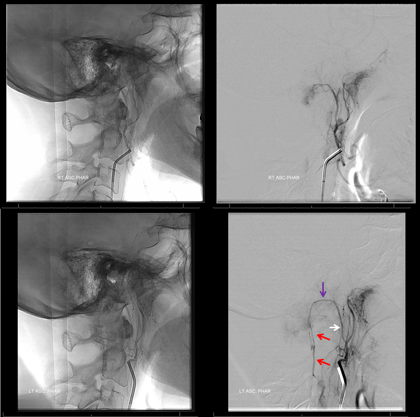 Foramen Magnum Mening Embolization