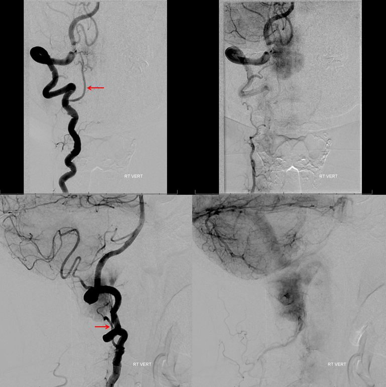 Foramen Magnum Mening Embolization