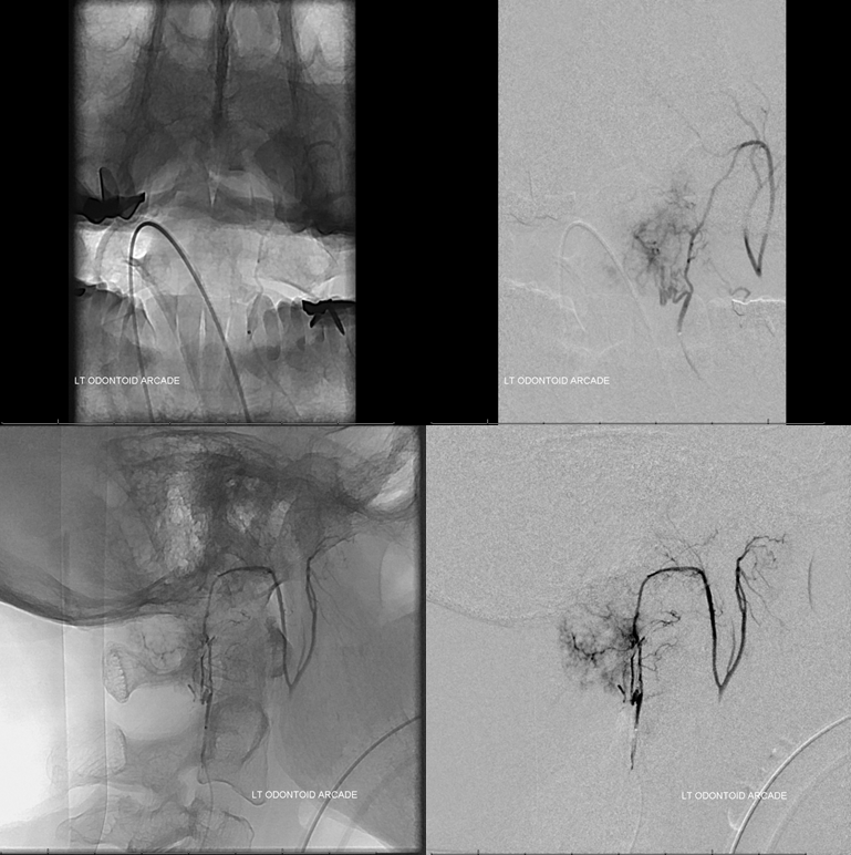 Foramen Magnum Mening Embolization