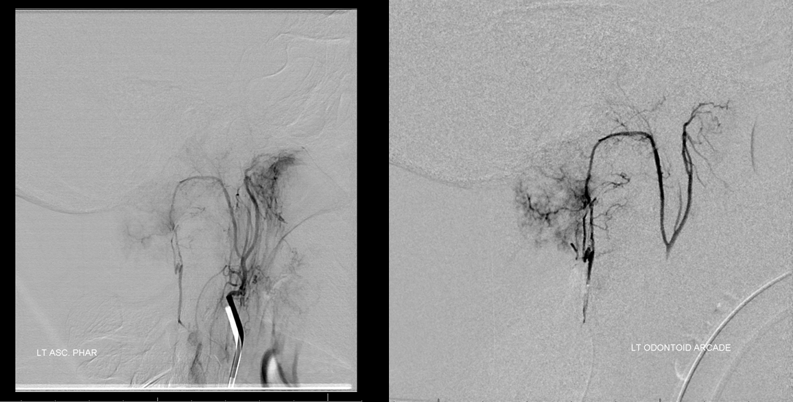 Foramen Magnum Mening Embolization