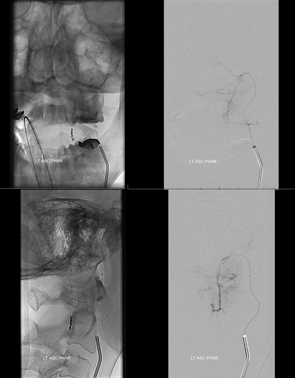 Foramen Magnum Mening Embolization