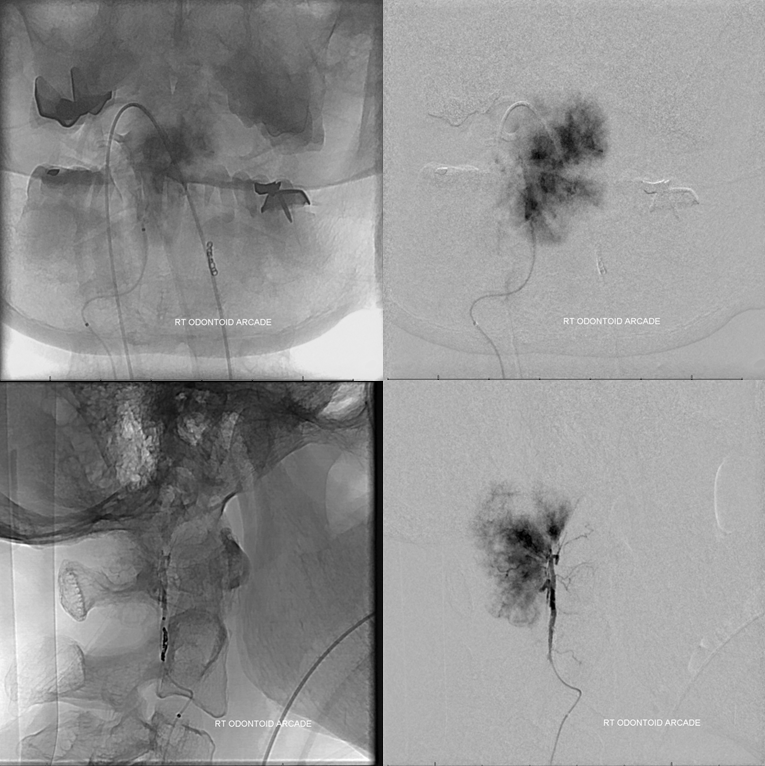 Foramen Magnum Mening Embolization