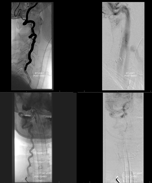 Foramen Magnum Mening Embolization