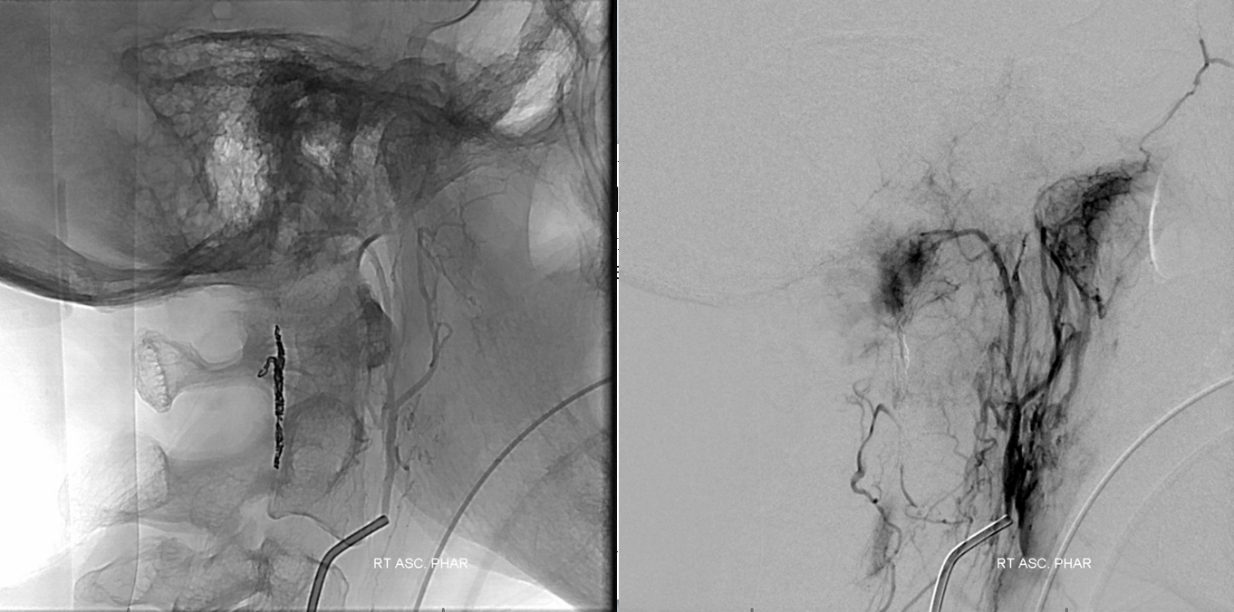 Foramen Magnum Mening Embolization