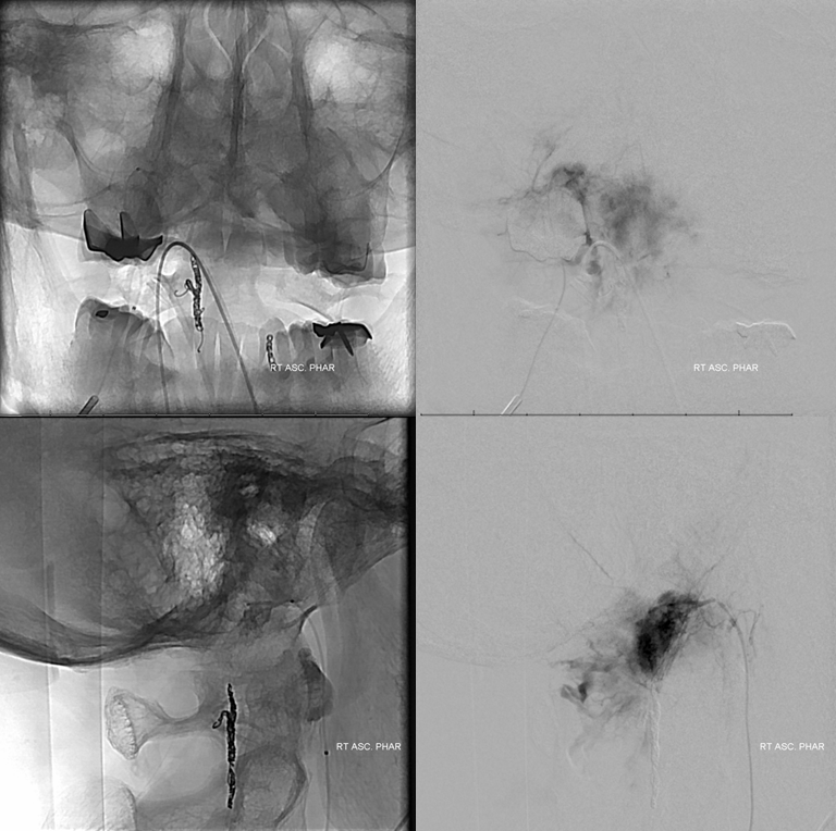 Foramen Magnum Mening Embolization