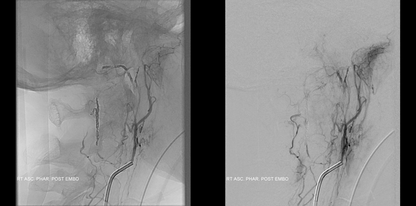 Foramen Magnum Mening Embolization