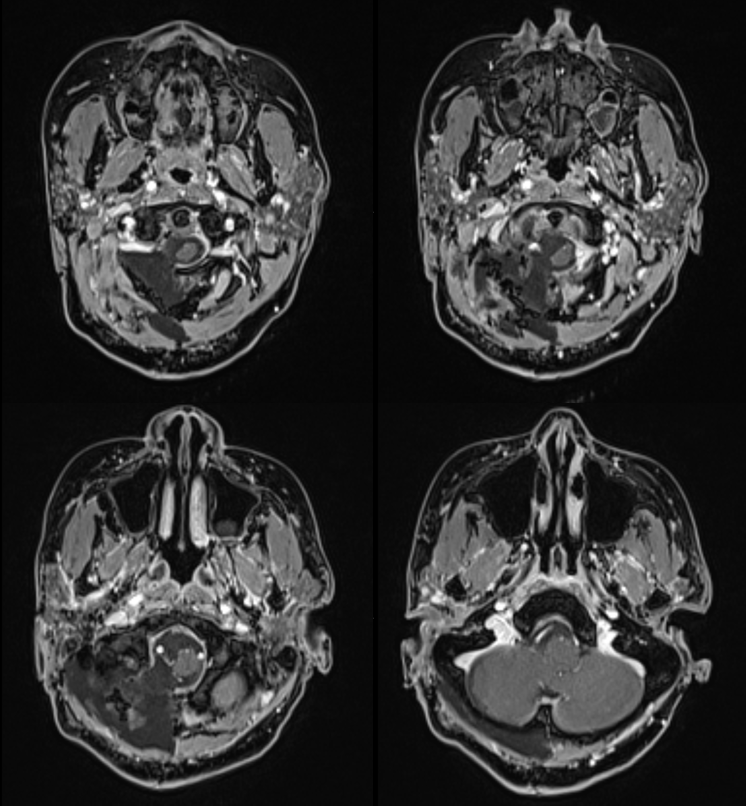 Foramen Magnum Mening Embolization