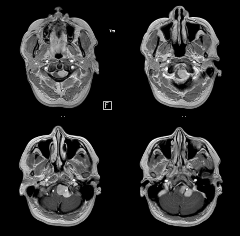 Foramen Magnum Meningioma Embolization