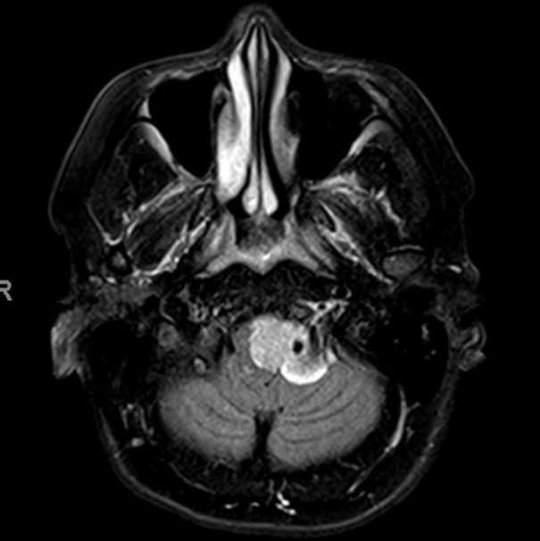 Foramen Magnum Meningioma Embolization