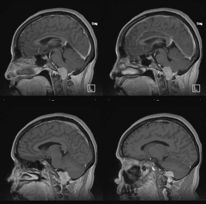 Foramen Magnum Meningioma Embolization