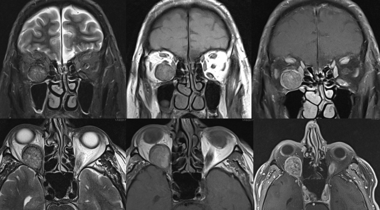 Orbital Metastasis Embolization