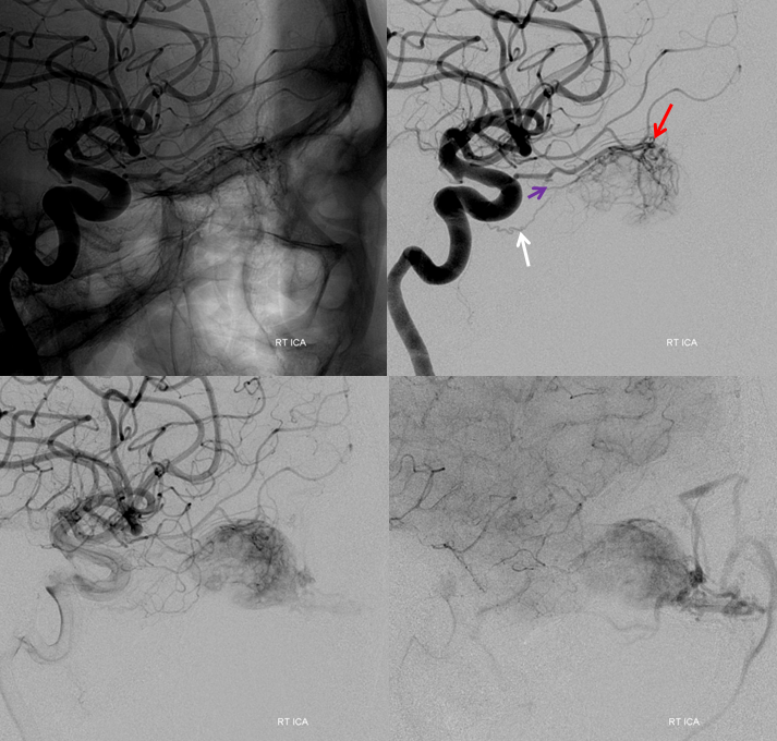 Orbital Metastasis Embolization