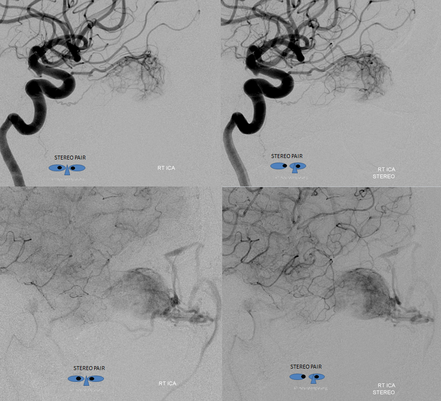 Orbital Metastasis Embolization