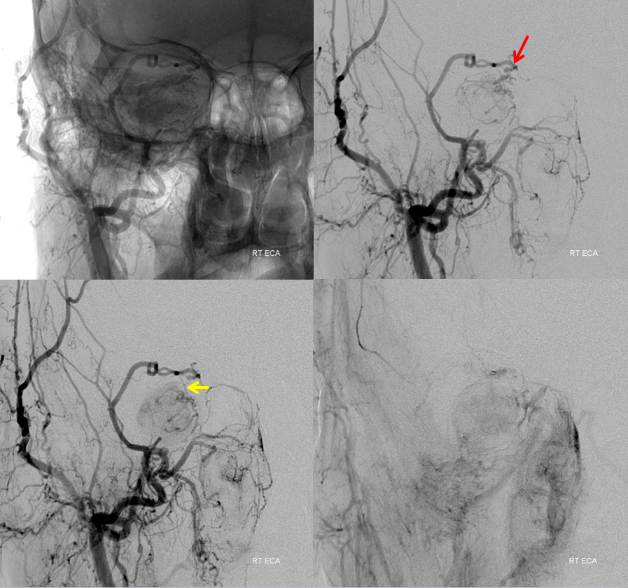 Orbital Metastasis Embolization