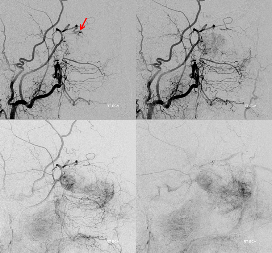 Orbital Metastasis Embolization