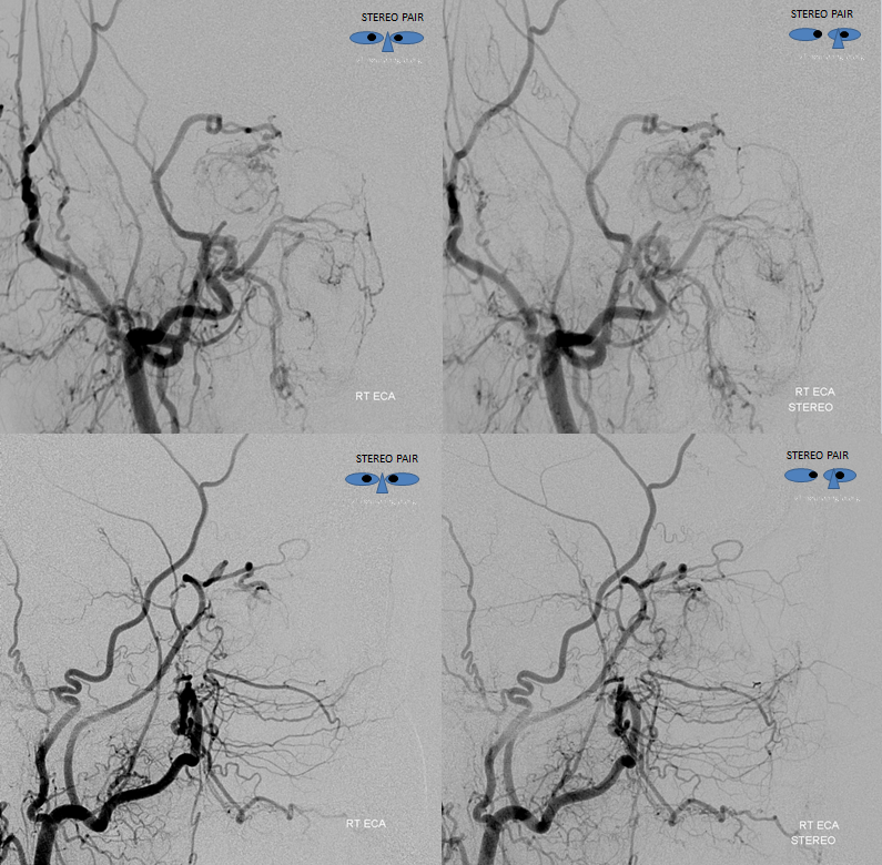 Orbital Metastasis Embolization