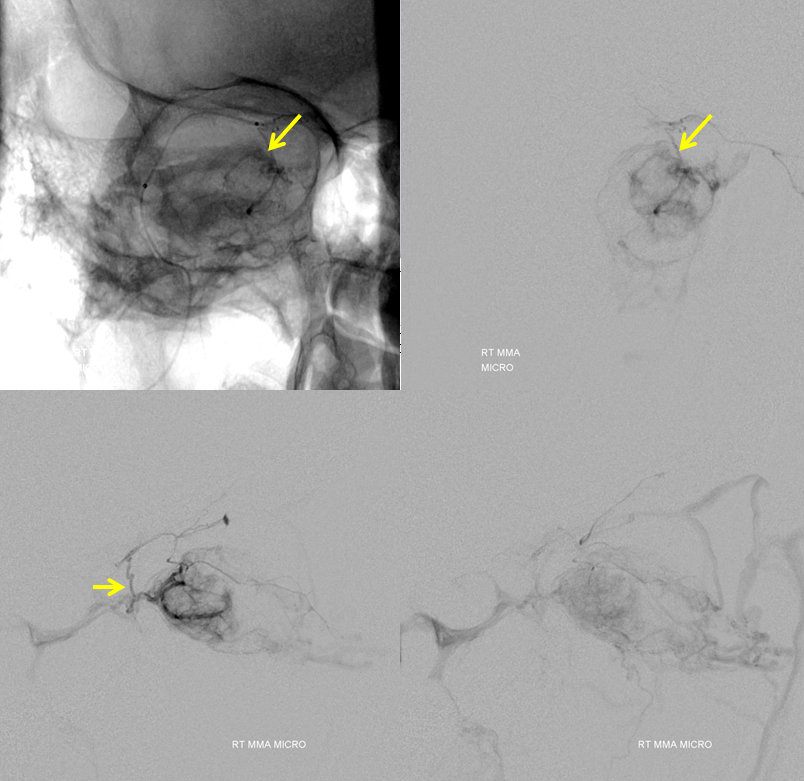 Orbital Metastasis Embolization