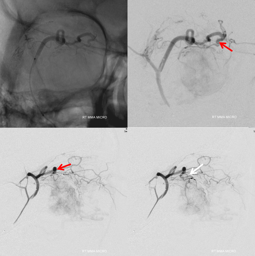 Orbital Metastasis Embolization