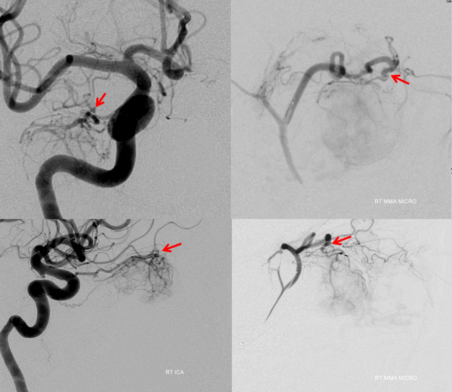 Orbital Metastasis Embolization