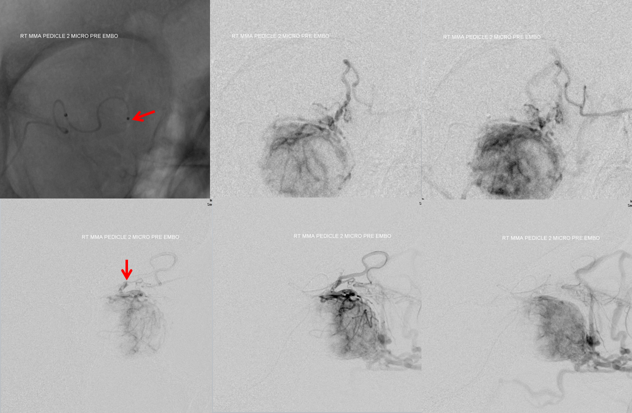 Orbital Metastasis Embolization