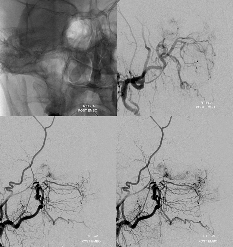 Orbital Metastasis Embolization