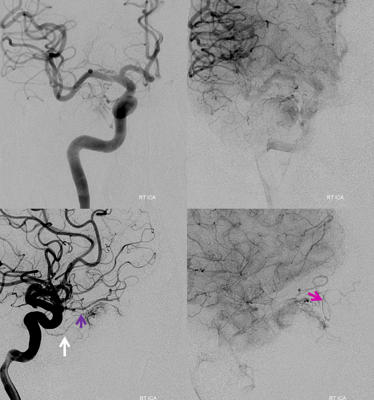 Orbital Metastasis Embolization