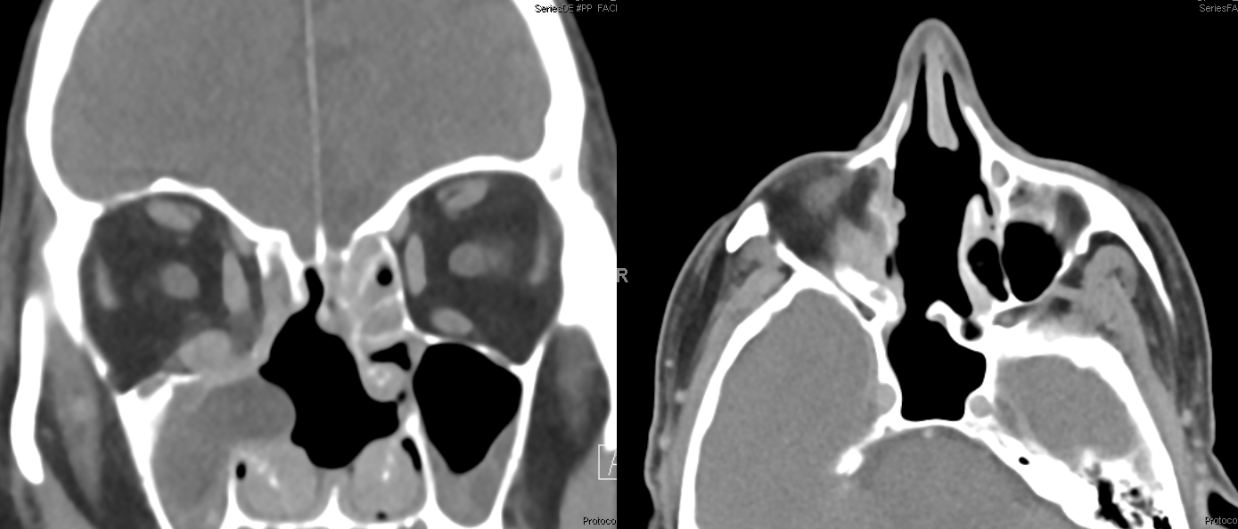 Orbital Metastasis Embolization