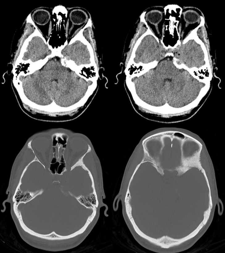 skull base meningioma embo