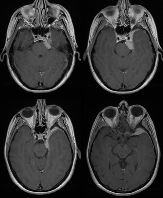 skull base meningioma embo