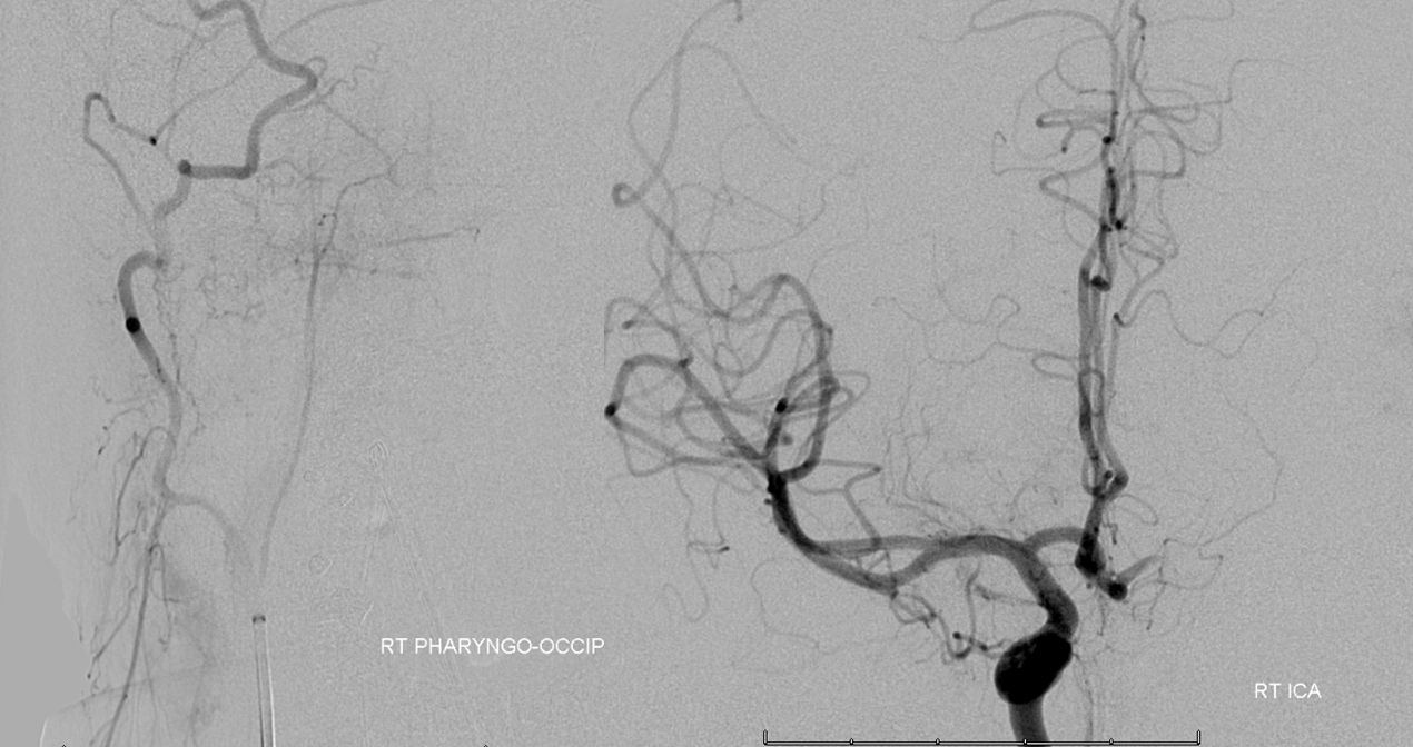 skull base meningioma embo