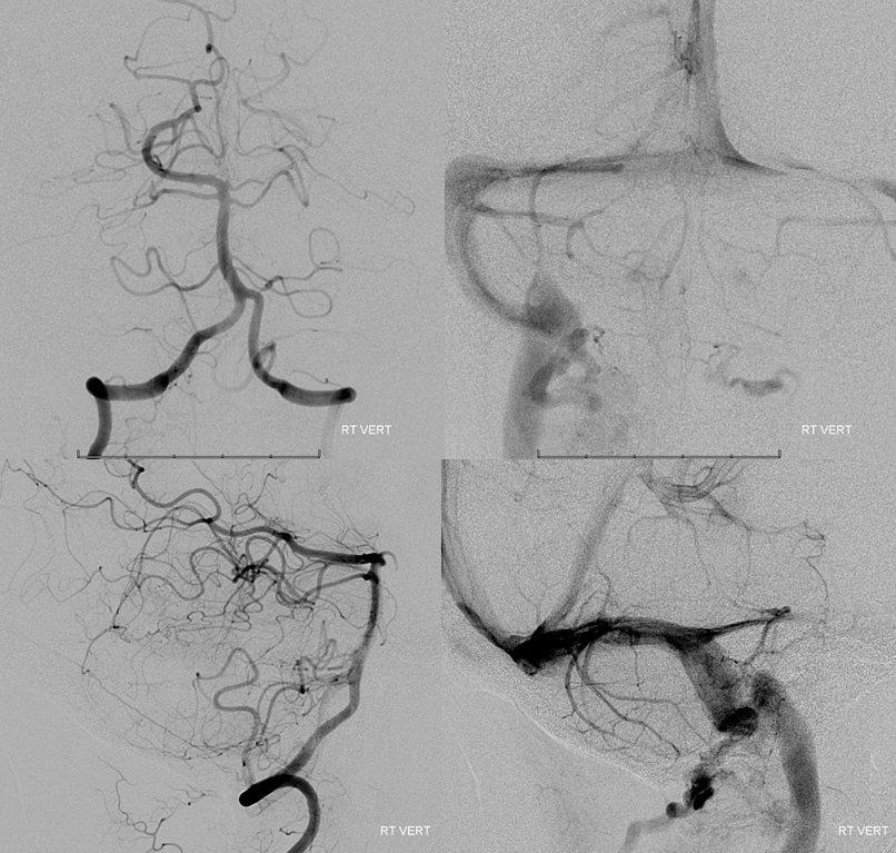 skull base meningioma embo