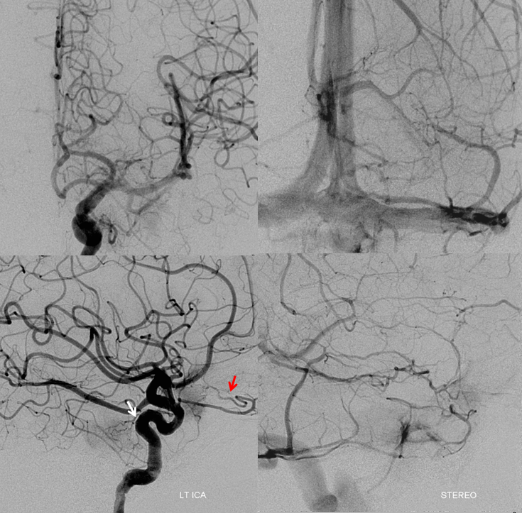 skull base meningioma embo