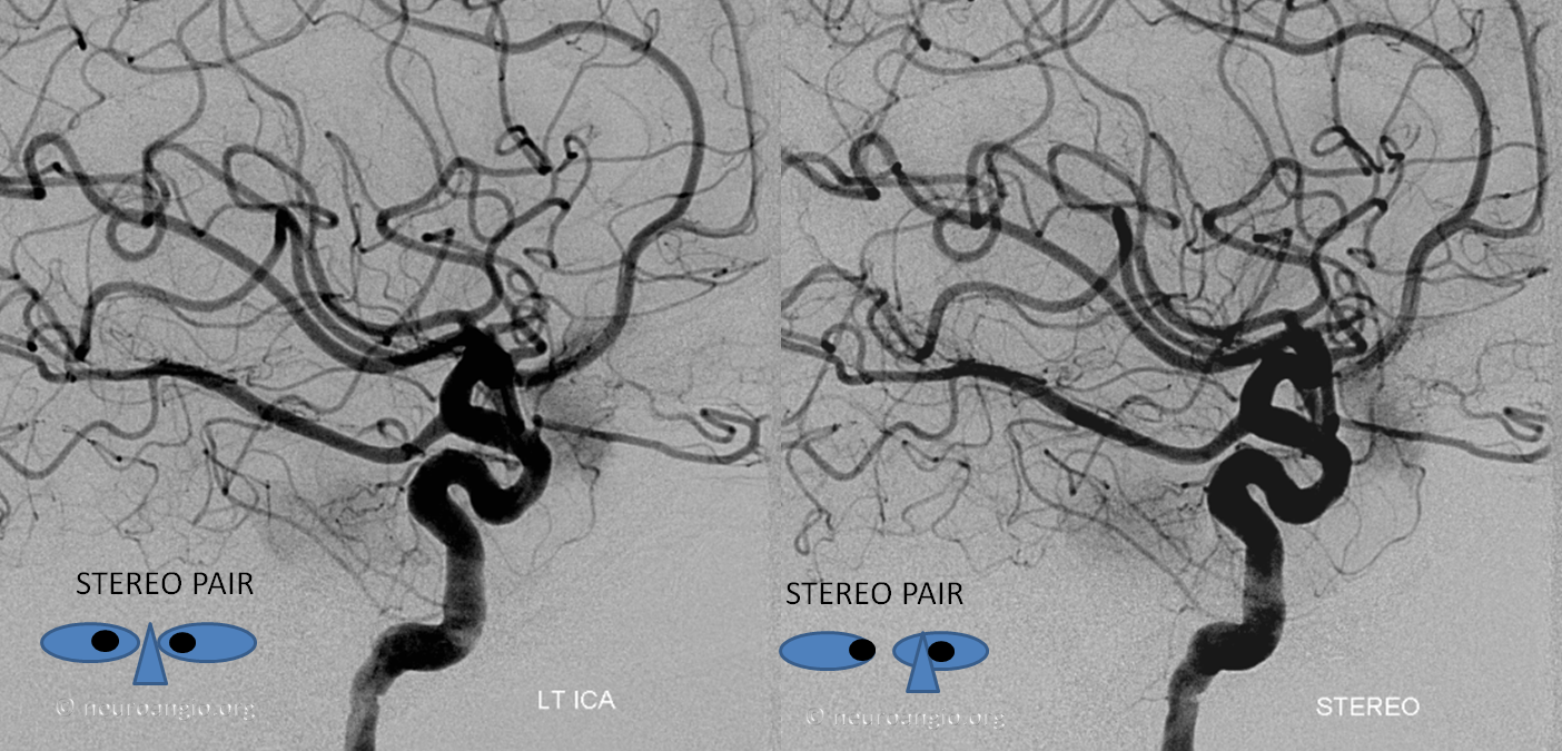 skull base meningioma embo