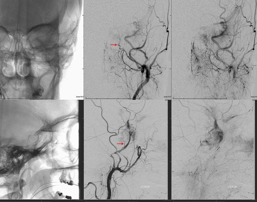 skull base meningioma embo