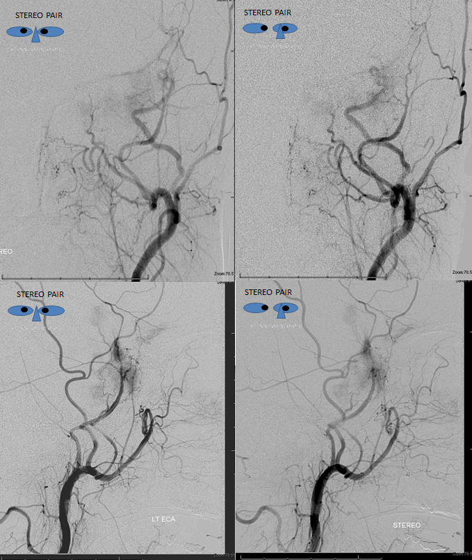 skull base meningioma embo