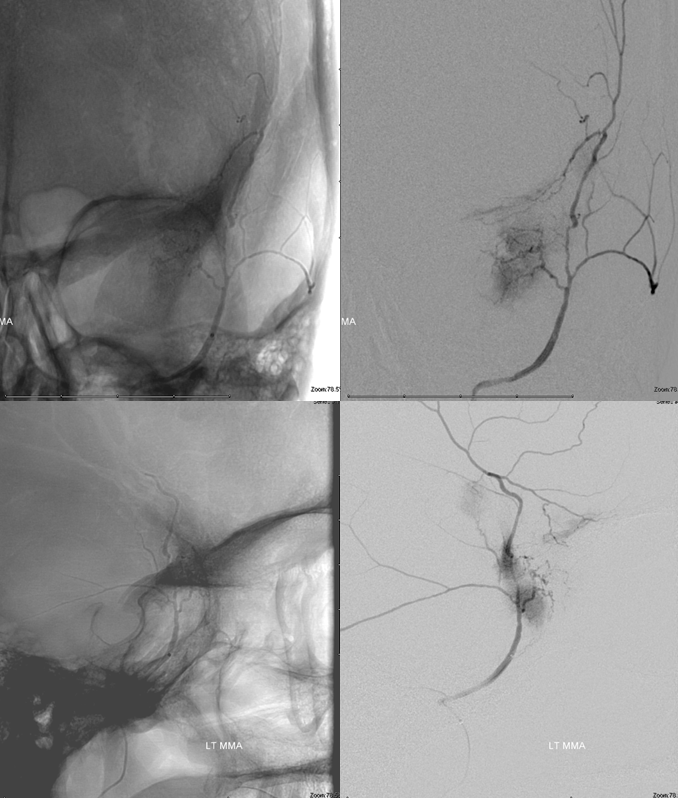 skull base meningioma embo