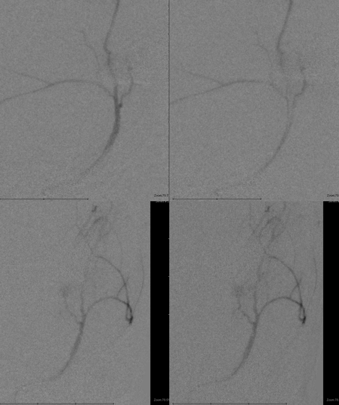 skull base meningioma embo