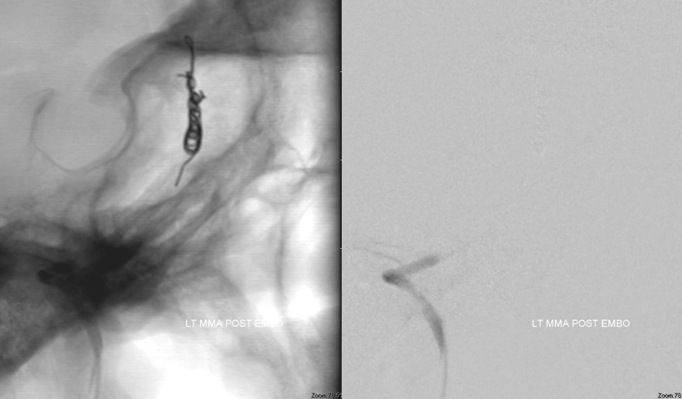 skull base meningioma embo